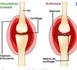 Ce qu'il faut savoir sur l'arthrose
