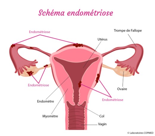 Endométriose : attention tabou !