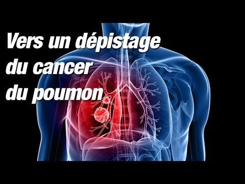 Cancer du poumon : une vaste étude contredit la HAS sur l’intérêt d’un dépistage systématique