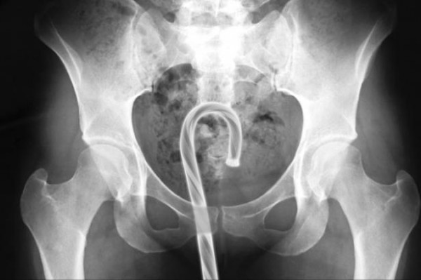 Top 10 des accidents sexuels les plus gênants… Top 10 des accidents sexuels les plus gênants…