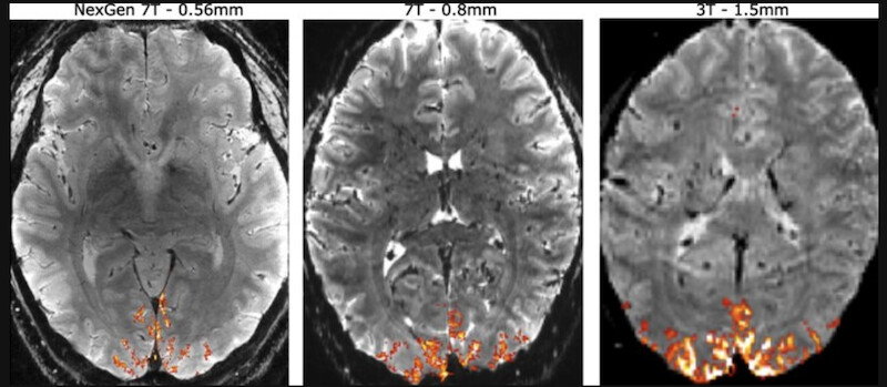 Image produite par un scanner à 7 Tesla par rapport à un 3 Tesla