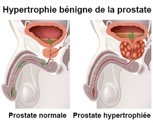 On voit très bien sur ce dessin comment une hypertrophie de la prostate peut perturber le parcours de l'urine dans l'urètre