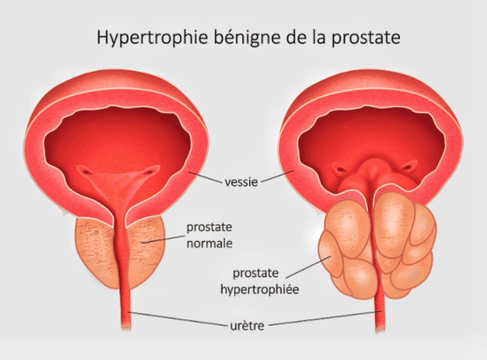 Fausses croyances sur la prostate