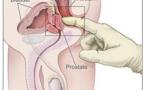 Le cancer de la prostate: un risque majeur pour les plus de 60 ans
