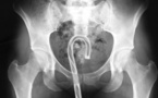 Top 10 des accidents sexuels les plus gênants…
