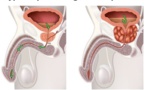 Des fruits pour réduire l'hypertrophie de la prostate