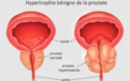 Fausses croyances sur la prostate