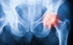 Arthrose : ne terminez pas en chaise roulante