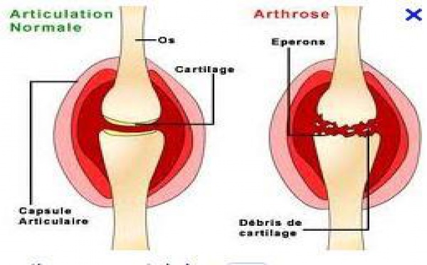Ce qu'il faut savoir sur l'arthrose