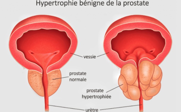 Fausses croyances sur la prostate