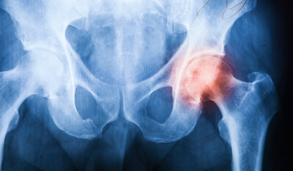 Arthrose : ne terminez pas en chaise roulante