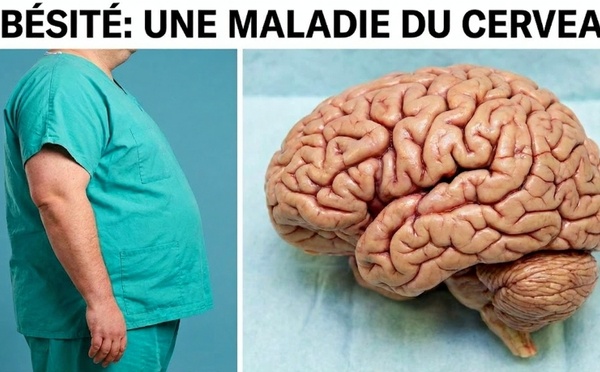 Pourquoi l'obésité est avant tout une maladie du cerveau.